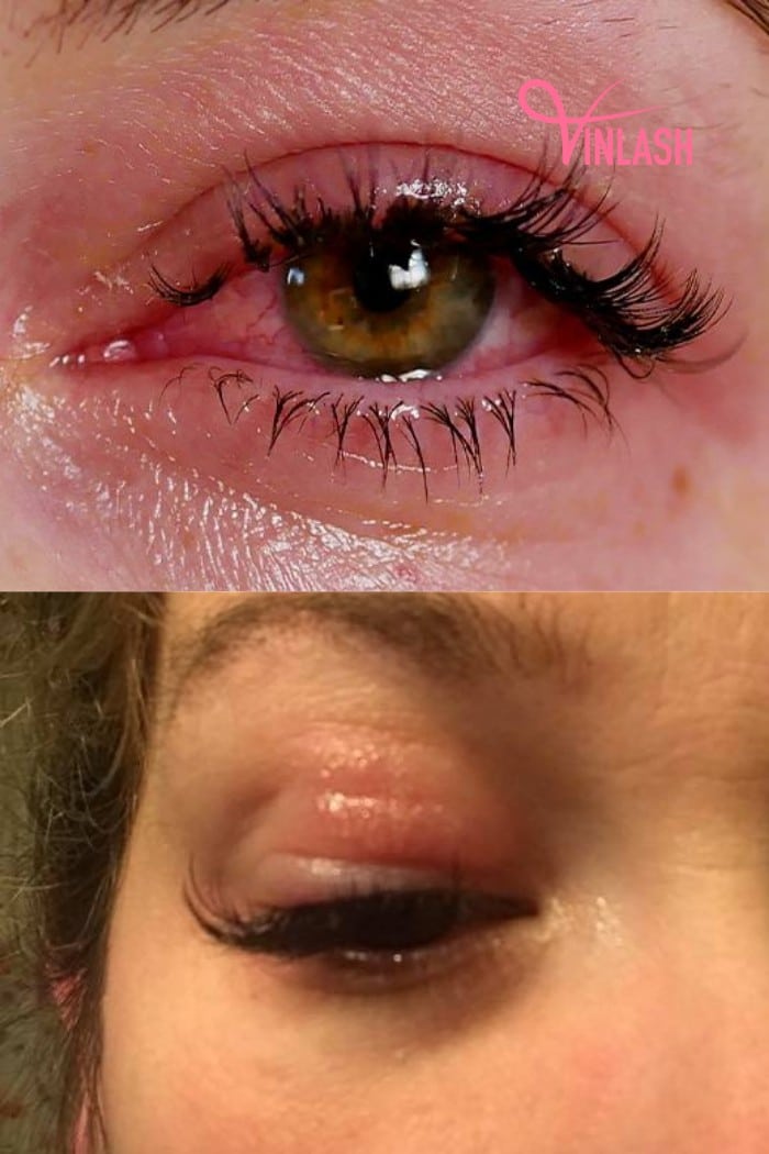 Understanding Allergic Reactions To Eyelash Extensions