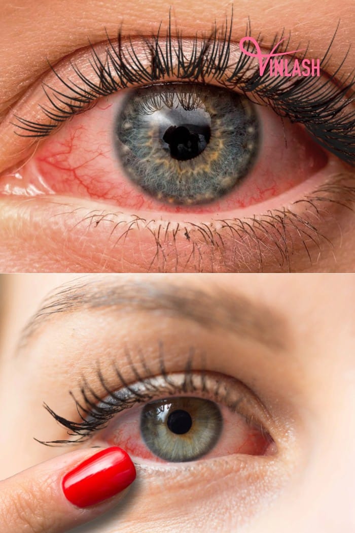 Allergic Reaction Symptoms in the Eyes