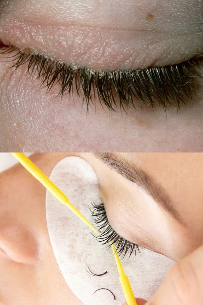How To Treat Blepharitis From Eyelash Extensions?