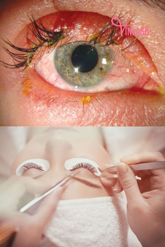 Chemical Burn Eyelash Extensions Explanation