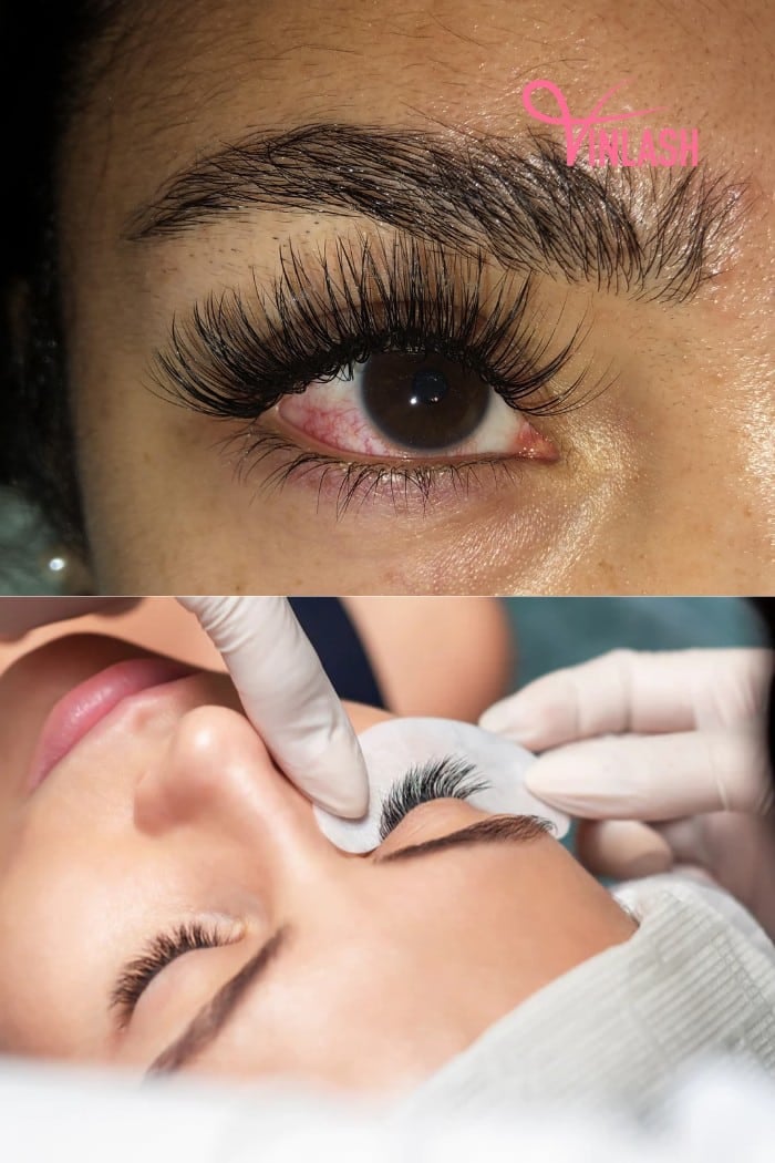Common Symptoms Of Bloodshot Eyes Following Eyelash Extensions